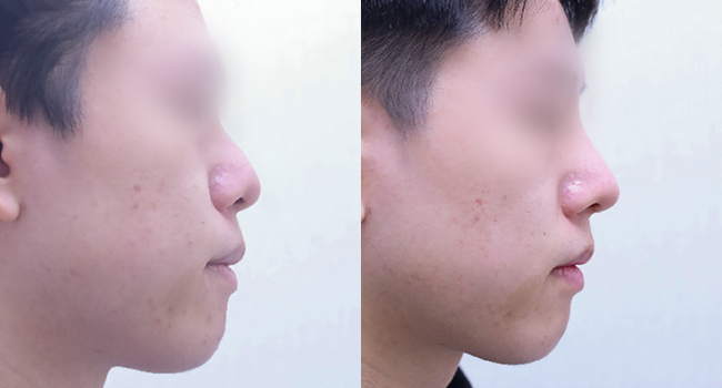 27세 남성  코성형 전후 사진