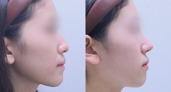 20세 여성  코성형 전후 사진