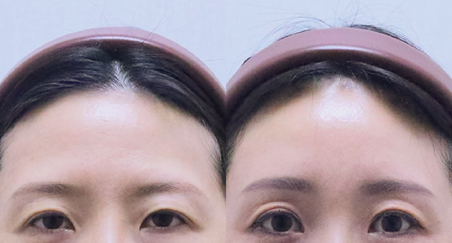 44세 여성  이마거상 전후 사진