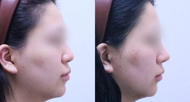 20세 여성  코성형 전후 사진