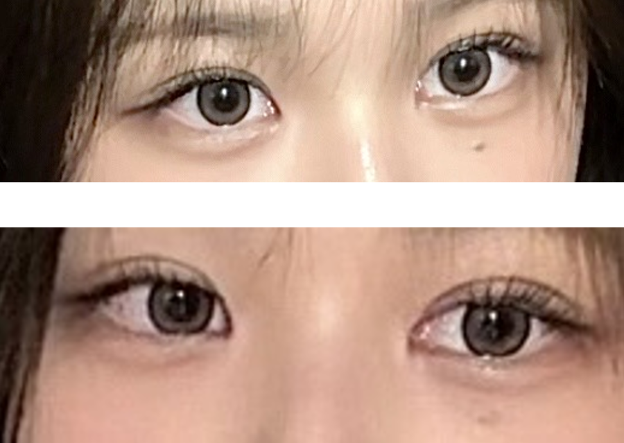 김OO님 / 자연유착 + 앞윗트임